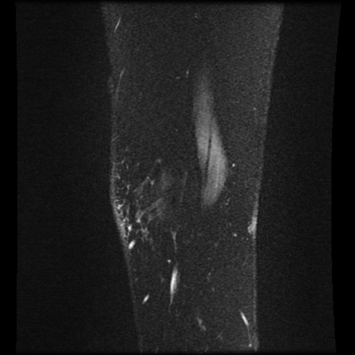 Bucket handle meniscus tear (Radiopaedia 56916-63751 H 84).jpg