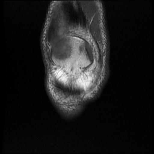 File:Bucket handle tear - medial meniscus (Radiopaedia 69245-79026 Coronal T1 2).jpg