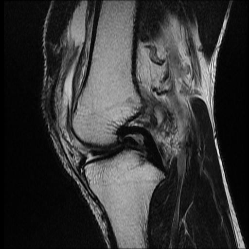 File:Bucket handle tear - medial meniscus (Radiopaedia 69245-79026 Sagittal T2 9).jpg