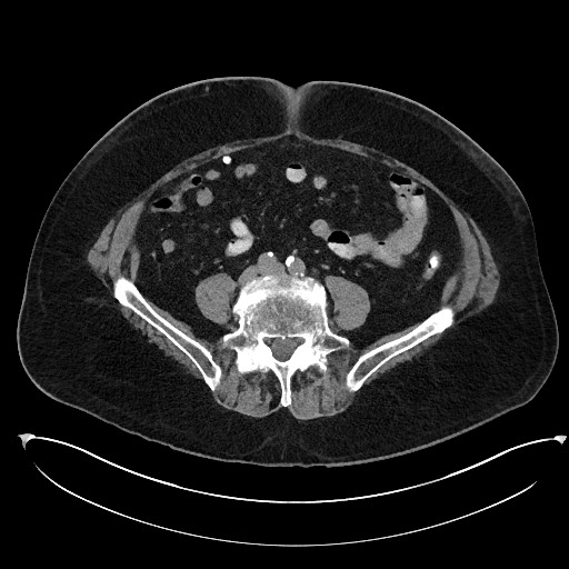 File:Buried bumper syndrome - gastrostomy tube (Radiopaedia 63843-72577 Axial Inject 79).jpg