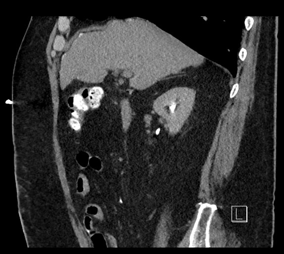 Buried bumper syndrome - gastrostomy tube (Radiopaedia 63843-72577 Sagittal Inject 82).jpg