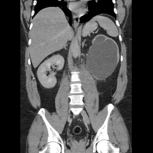 Burned-out testicular seminoma - retroperitoneal nodal metastases (Radiopaedia 62872-71245 B 41).jpg