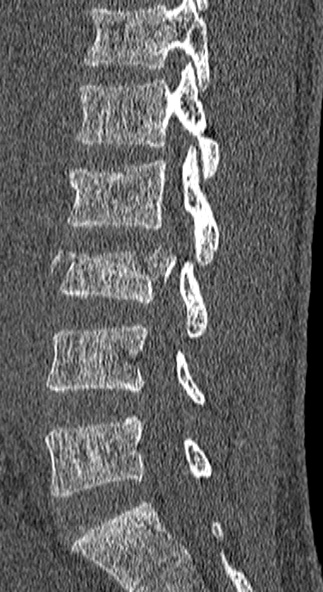 Burst fracture (Radiopaedia 53373-59357 Sagittal bone window 44).jpg