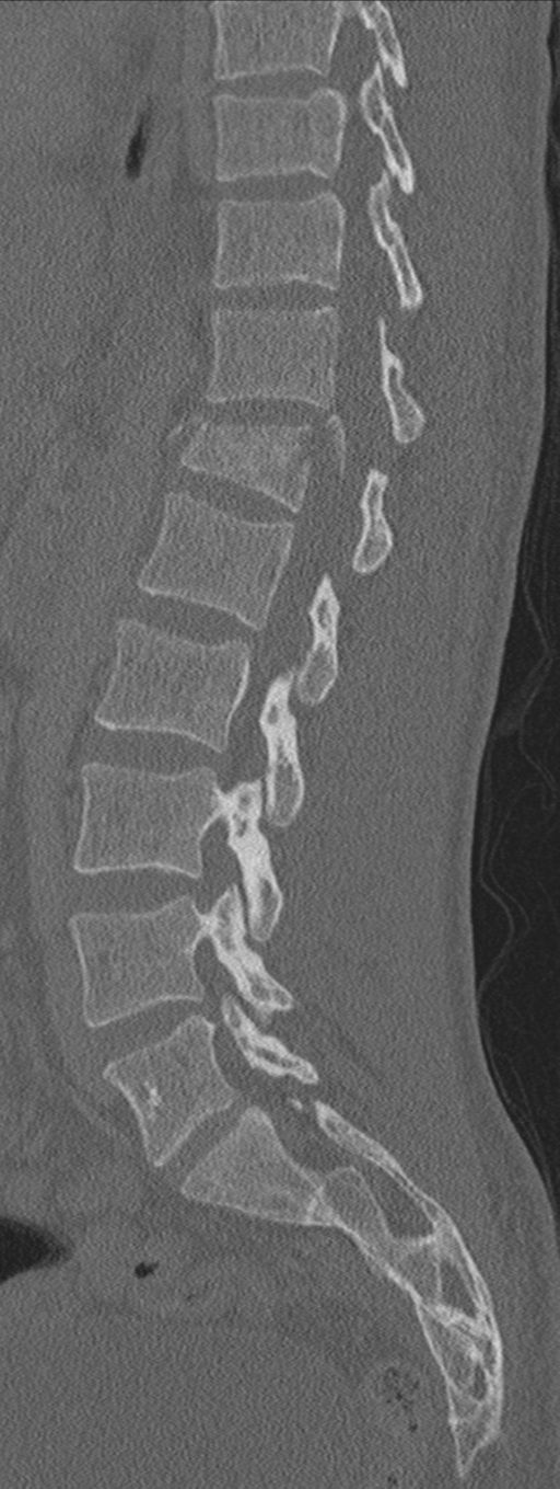 Burst fracture - T12 with conus compression (Radiopaedia 56825-63647 Sagittal bone window 36).png