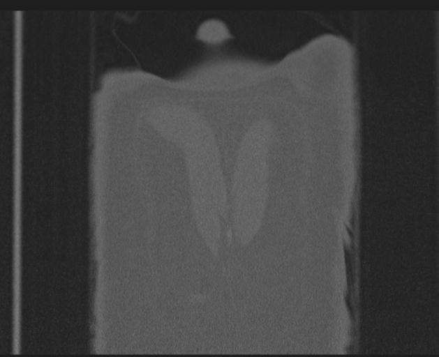 Burst fracture - thoracic spine (Radiopaedia 30238-30865 Coronal bone window 160).jpg