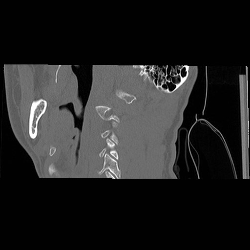 File:C1-C2 "subluxation" - normal cervical anatomy at maximum head rotation (Radiopaedia 42483-45607 C 55).jpg