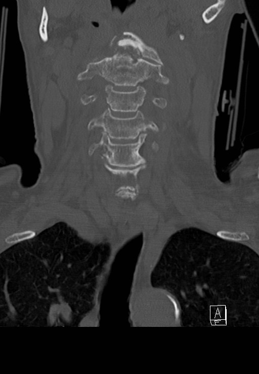 C1 and C2 (peg) fractures (Radiopaedia 36618-38184 Coronal bone window 17).jpg