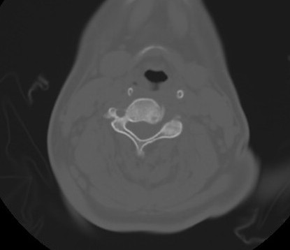 C7 laminar fracture and Klippel-Feil syndrome (Radiopaedia 86710-102850 Axial bone window 42).jpg