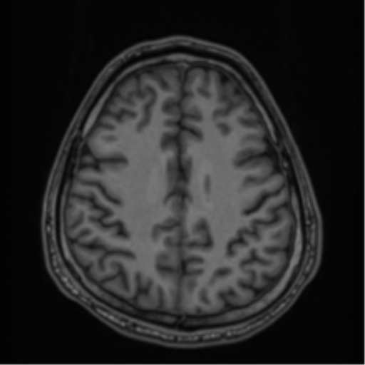 CNS vasculitis (Radiopaedia 55715-62263 Axial T1 64).png