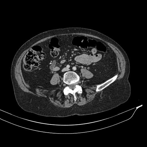 Calcified adrenal glands and Spigelian hernia (Radiopaedia 49741-54988 A 137).jpg