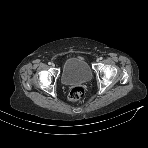 Calcified adrenal glands and Spigelian hernia (Radiopaedia 49741-54988 A 230).jpg
