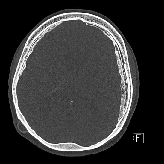 Calcified chronic subdural hematoma (Radiopaedia 77374-89492 Axial bone window 74).jpg