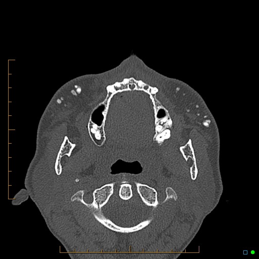 Calcified facial augmentation fillers (Radiopaedia 79514-92679 Axial bone window 77).jpg