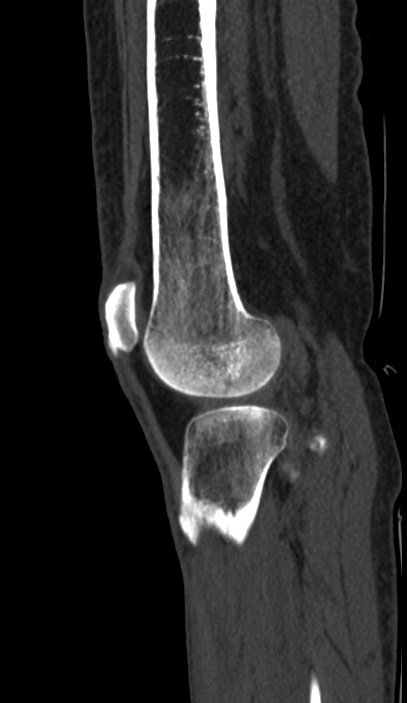 Calcified hematoma - popliteal fossa (Radiopaedia 63938-72763 Sagittal bone window 94).jpg