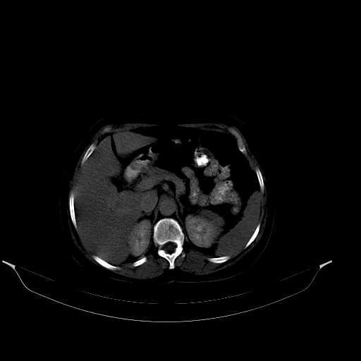 File:Calcified hydatid cyst of the liver (Radiopaedia 21212-21112 Axial bone window 17).jpg