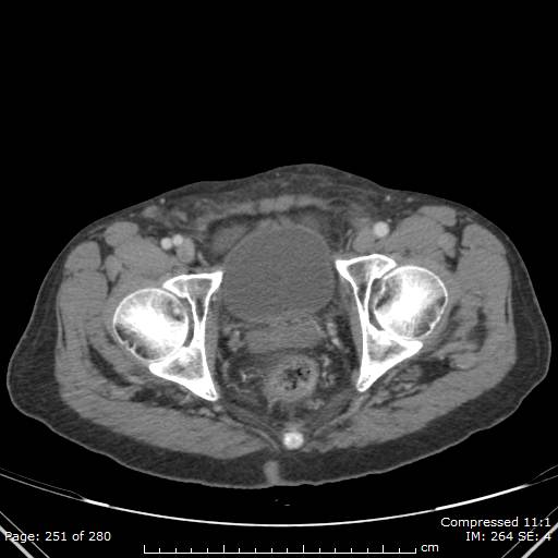 Calcified liver metastases (Radiopaedia 44699-48470 B 60).jpg