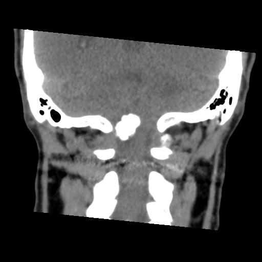 Calcifying pseudoneoplasm of neuraxis (Radiopaedia 44076-47617 Coronal non-contrast 31).png