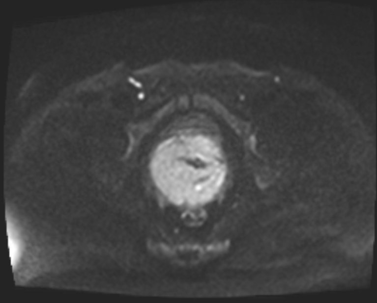 Cancer cervix - stage IIb (Radiopaedia 75411-86615 Axial DWI 70).jpg