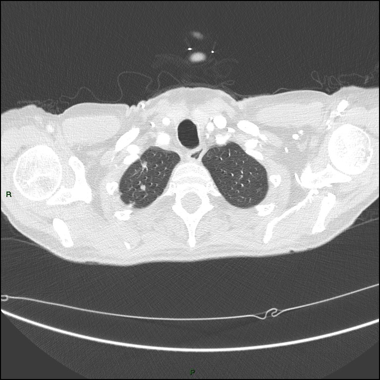 Cannonball metastases (Radiopaedia 82110-96150 Axial lung window 28).jpg