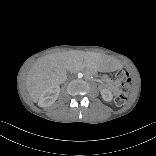 Cannonball metastases - testicular choriocarcinoma (Radiopaedia 84510-99891 B 130).jpg