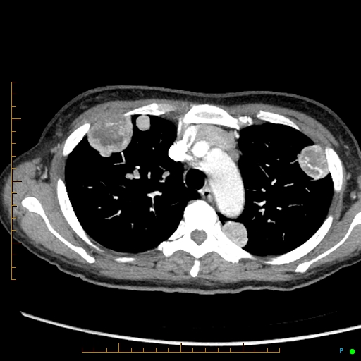 Canonball lung metastasis (Radiopaedia 77634-89837 B 24).jpg