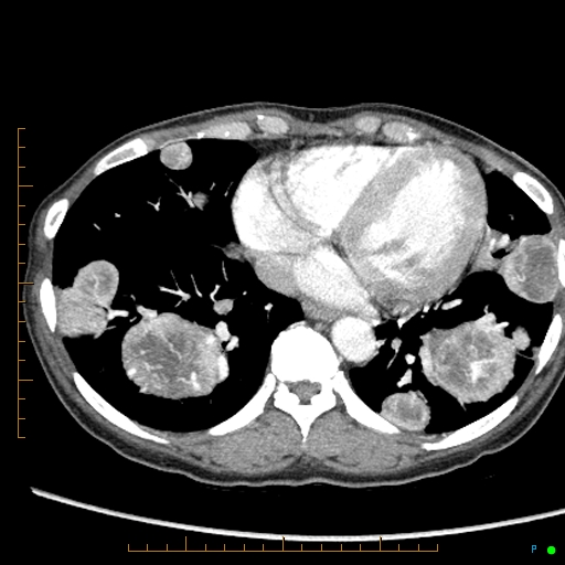 Canonball lung metastasis (Radiopaedia 77634-89837 B 72).jpg