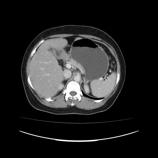 File:Carcinoma colon - hepatic flexure (Radiopaedia 19461-19493 A 37).jpg