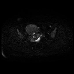 Carcinoma of the cervix (Radiopaedia 89018-105858 Axial DWI 35).jpg