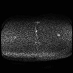 Carcinoma of the cervix (Radiopaedia 89018-105858 Axial DWI 61).jpg