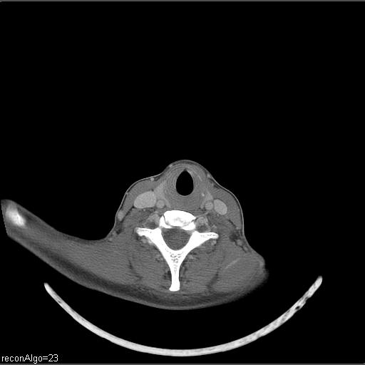 Carcinoma of the maxillary antrum (Radiopaedia 53805-59888 Axial C+ delayed 13).jpg