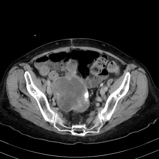 Carcinosarcoma (Radiopaedia 70401-80503 A 53).jpg