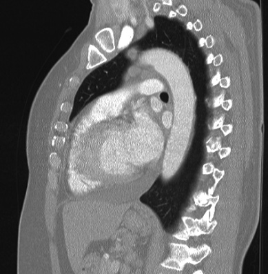 Cardiac sarcoidosis (Radiopaedia 74548-85534 Sagittal lung window 38).jpg