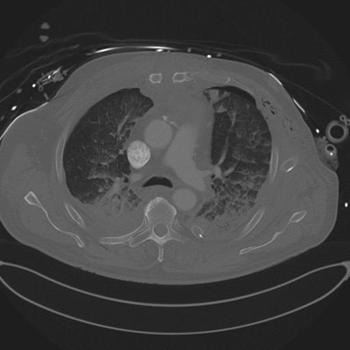 Cardiac trauma (Radiopaedia 32874-33858 Axial bone window 34).jpg