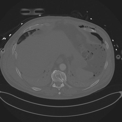 Cardiac trauma (Radiopaedia 32874-33858 Axial bone window 75).jpg