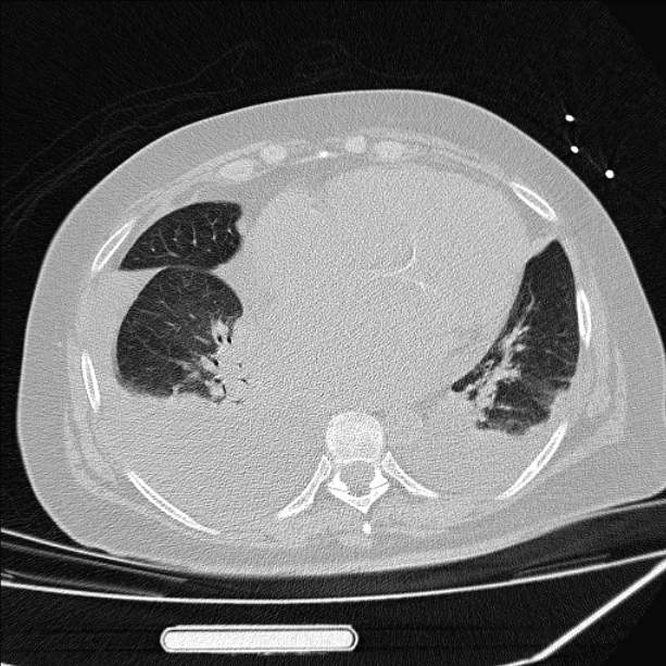 Cardiogenic pulmonary edema (Radiopaedia 29213-29609 Axial lung window 67).jpg