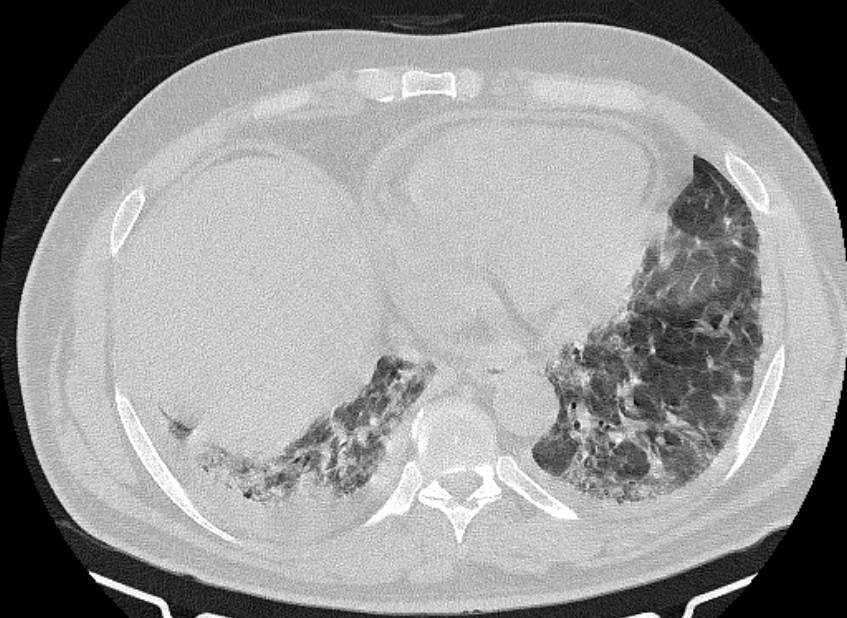 Cardiogenic pulmonary edema (Radiopaedia 68180-77678 Axial lung window 76).jpg