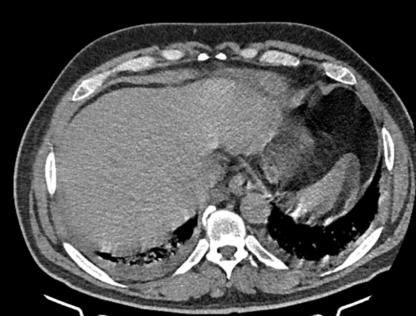 Cardiogenic pulmonary edema (Radiopaedia 68180-77678 Axial non-contrast 46).jpg
