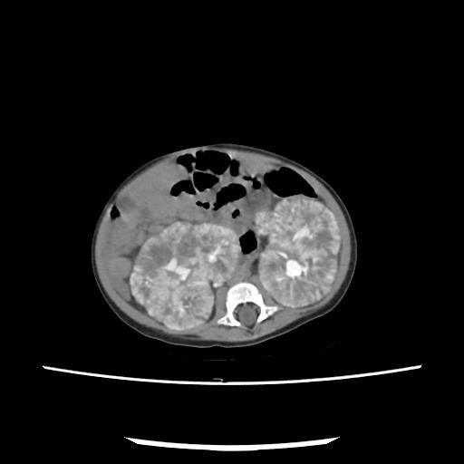 Caroli disease with autosomal recessive polycystic kidney disease (ARPKD) (Radiopaedia 89651-106703 E 132).jpg