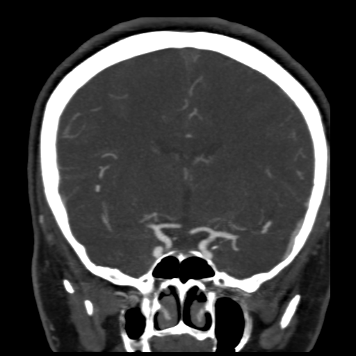 File:Carotico ophthalmic aneurysm (Radiopaedia 42916-46148 B 5).png