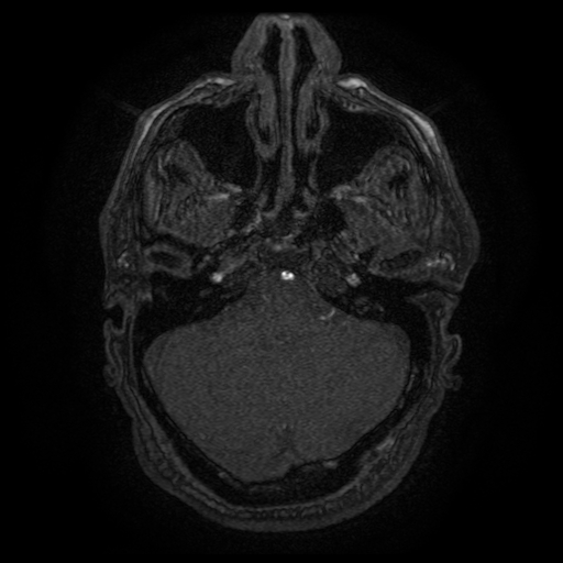 Carotid arterial dissection with acute cerebral infarction (Radiopaedia 26636-26784 MRA 139).jpg