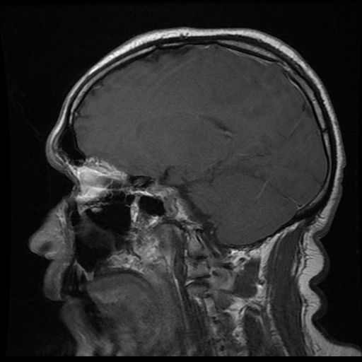 File:Carotid arterial dissection with acute cerebral infarction (Radiopaedia 26636-26784 Sagittal T1 C+ 12).jpg
