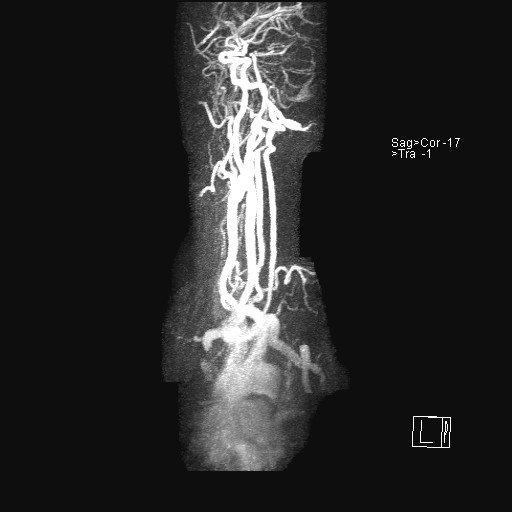 File:Carotid artery dissection (Radiopaedia 28441-28689 MIP Carotids MRA 25).jpg
