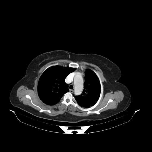 File:Carotid body tumor (Radiopaedia 21021-20948 B 31).jpg