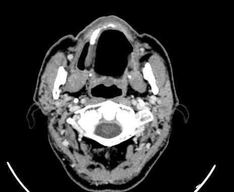 Carotid body tumor (Radiopaedia 61750-69757 Axial Post contrast 12).jpg