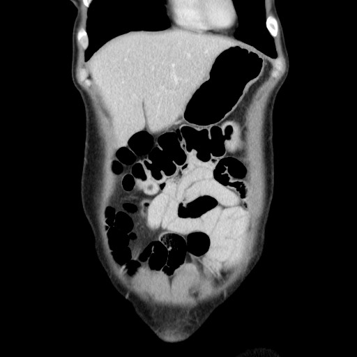 Castleman disease with fibrous pseudotumor in the abdomen (Radiopaedia 77296-89373 B 20).jpg