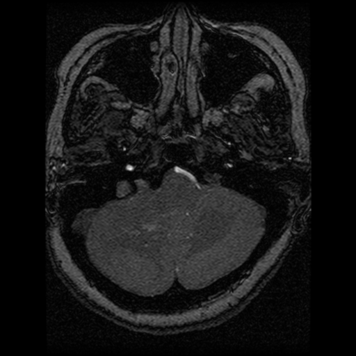Cavernoma, DVA and right ICA aneurysm (Radiopaedia 33890-35072 E 91).png