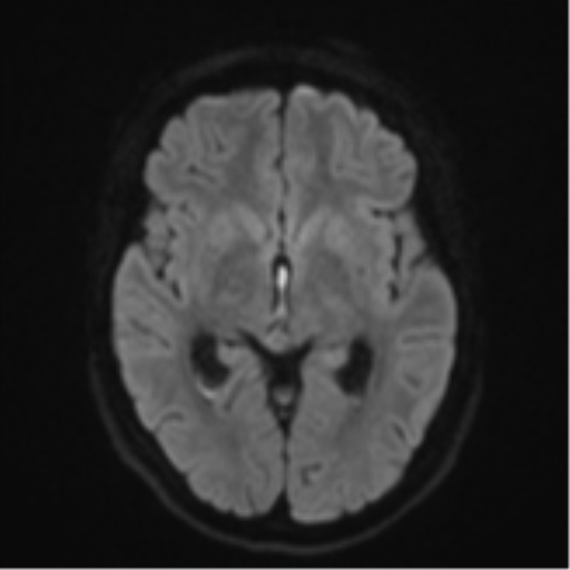 File:Cavernoma with bleed - midbrain (Radiopaedia 54546-60774 Axial DWI 40).png