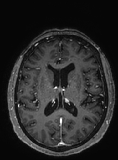 Cavernous hemangioma of the cerebellar falx (Radiopaedia 73025-83724 Axial T1 C+ 143).jpg