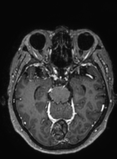 Cavernous hemangioma of the cerebellar falx (Radiopaedia 73025-83724 Axial T1 C+ 211).jpg