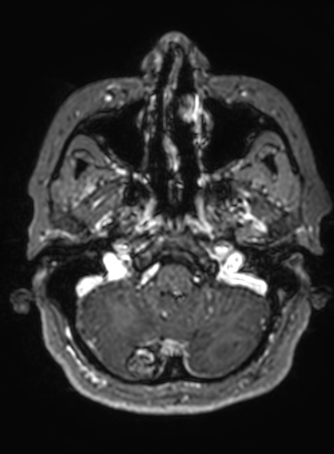 Cavernous hemangioma of the cerebellar falx (Radiopaedia 73025-83724 Axial T1 C+ 284).jpg